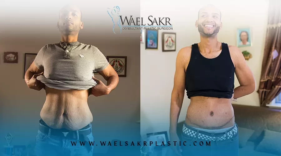 طرق ازالة الجلد الزائد بعد الرجيم image