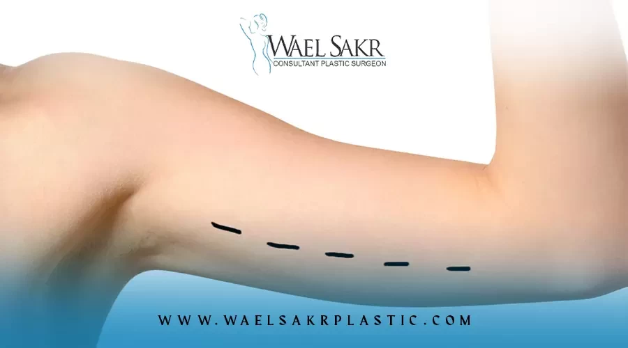 تجارب شفط دهون الذراعين image