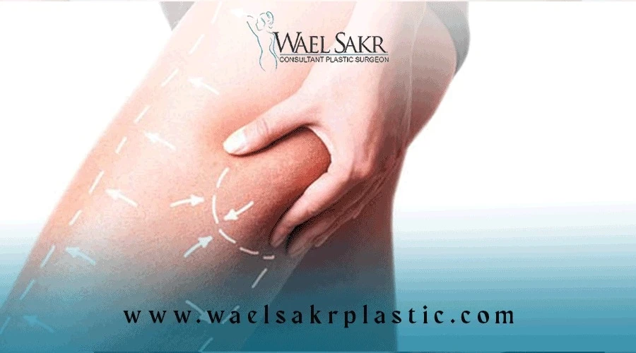 شد الفخذ المترهل image