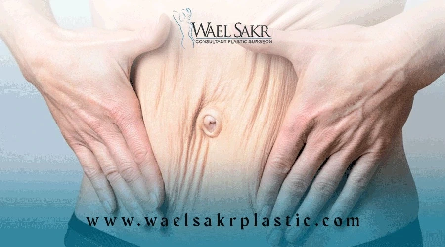 علاج ترهل الجسم بعد الرجيم image