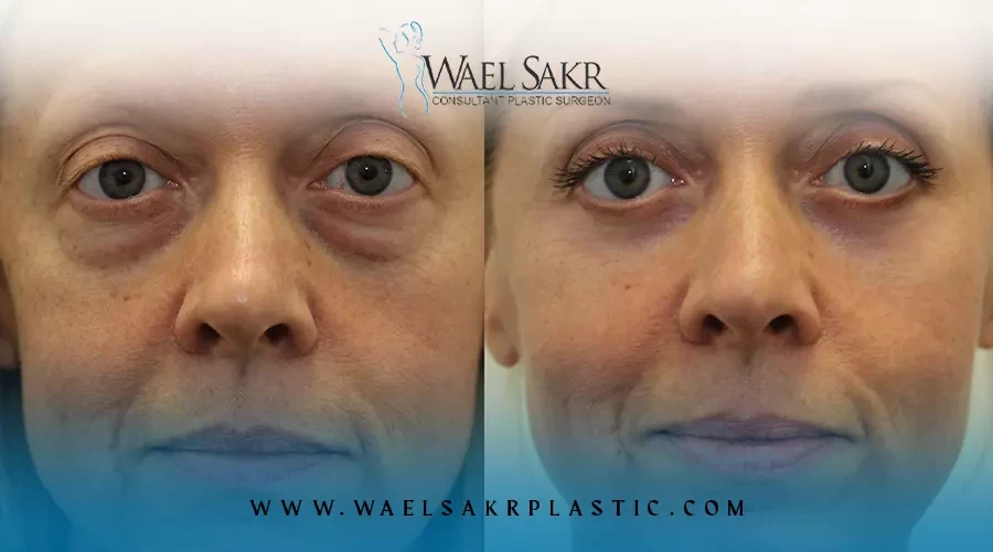 عملية شد جفن العين السفلي image