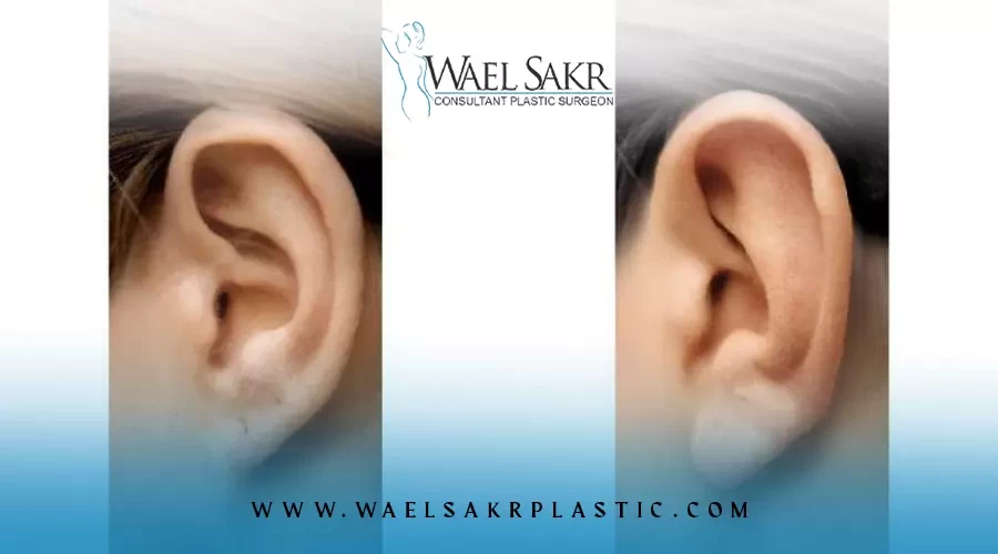 تجميل شحمة الاذن المتصلة والمنفصلة image