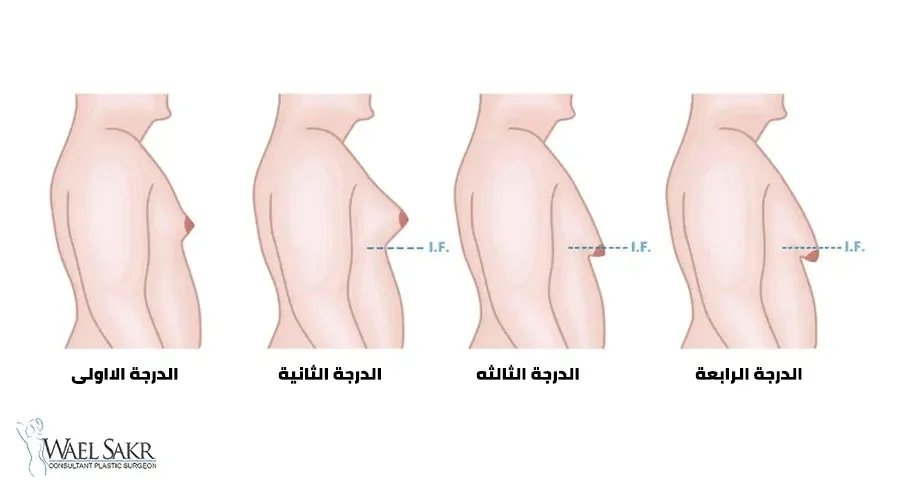 أنواع التثدي عند الرجال و درجات التثدي بالصور