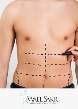 شفط الدهون image