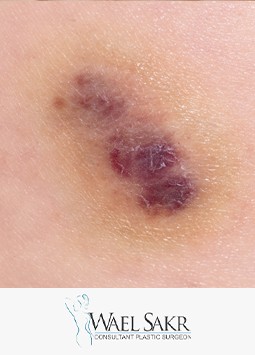 إصلاح أثار الحروق و التشوهات و الندبات بعد الحروق image