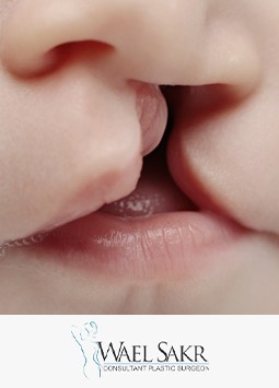 إصلاح جراحات الشفة الأرنبية و سقف الحلق image